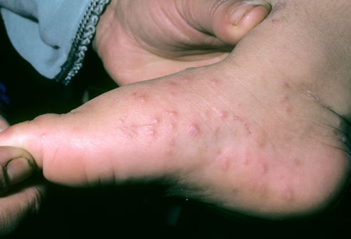rash on hands and feet only